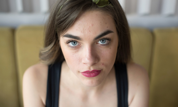 Врачи назвали продукты — провокаторы прыщей